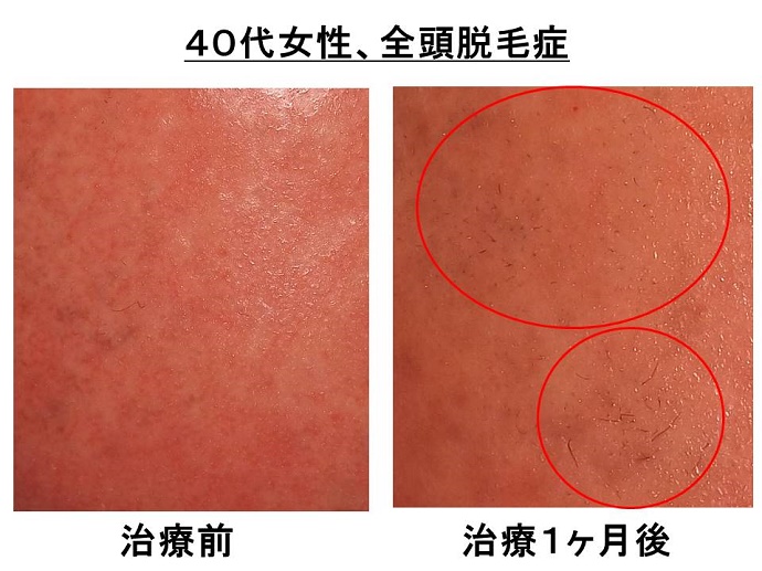 円形脱毛症　病院""
